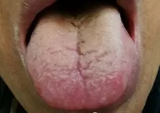 肝癌早期舌头图片图片
