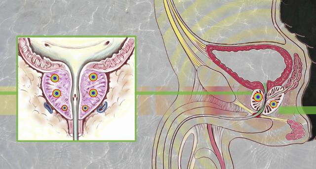 前列腺钙化图解图片
