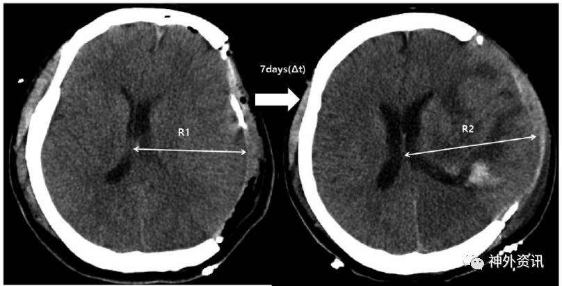 脑水肿图片分析图片