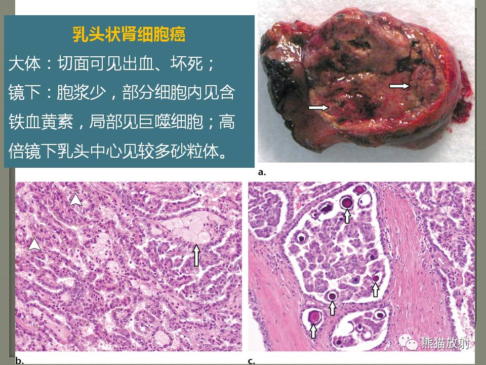 papillary rcc乳头状肾细胞癌clear cell rcc肾透明细胞癌