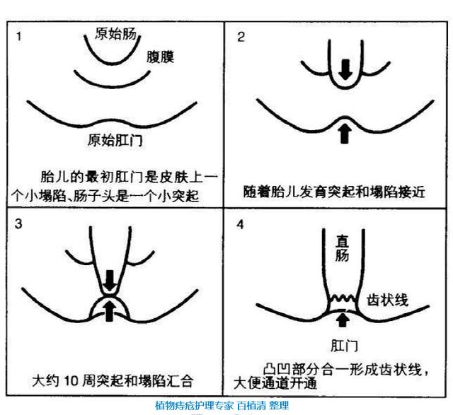 肛门皮赘和痔疮的区别图片