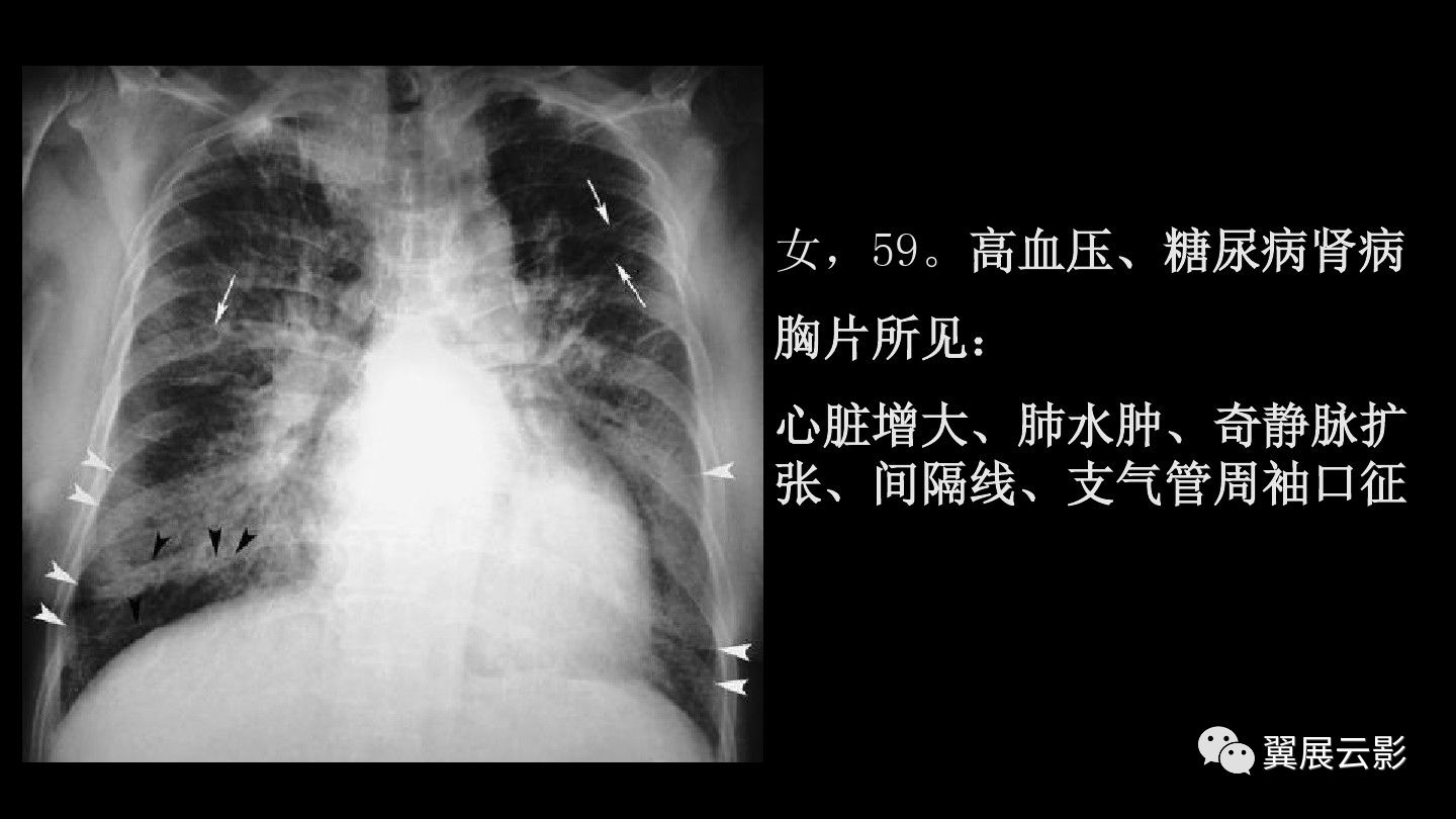 急性呼吸窘迫綜合徵ards的影像學表現