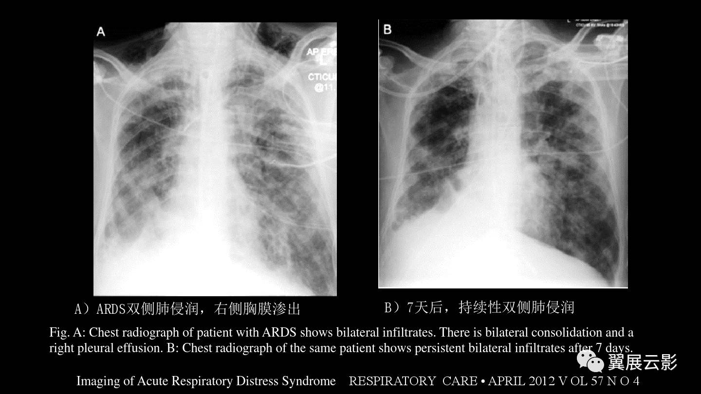 急性呼吸窘迫综合征ards的影像学表现