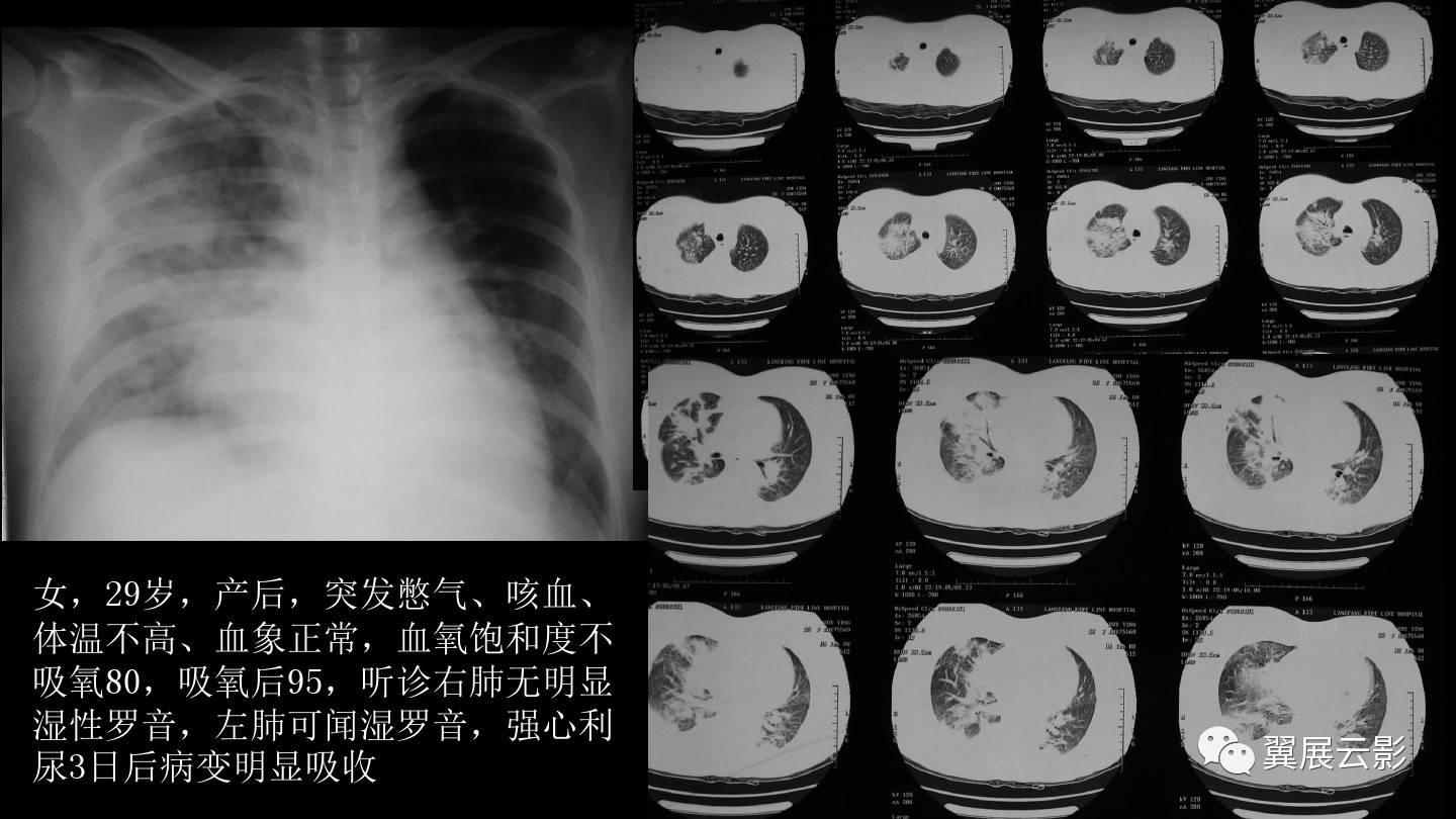 急性呼吸窘迫综合征ards的影像学表现