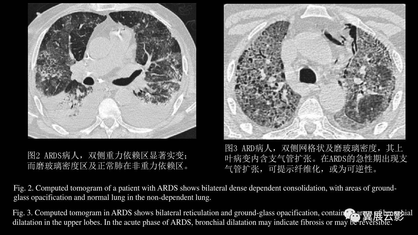 急性呼吸窘迫综合征ards的影像学表现