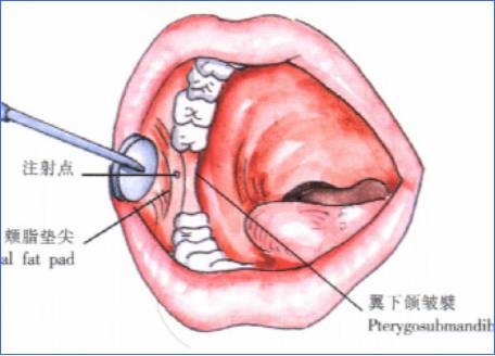 口腔麻醉区域图图片