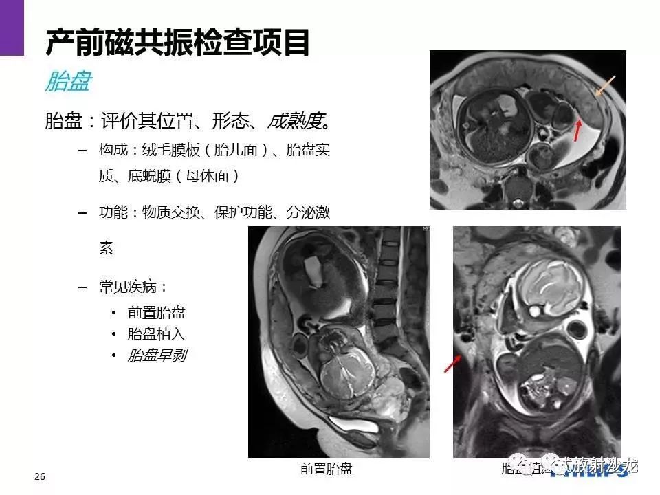 磁共振產前檢查胎兒胎盤大全