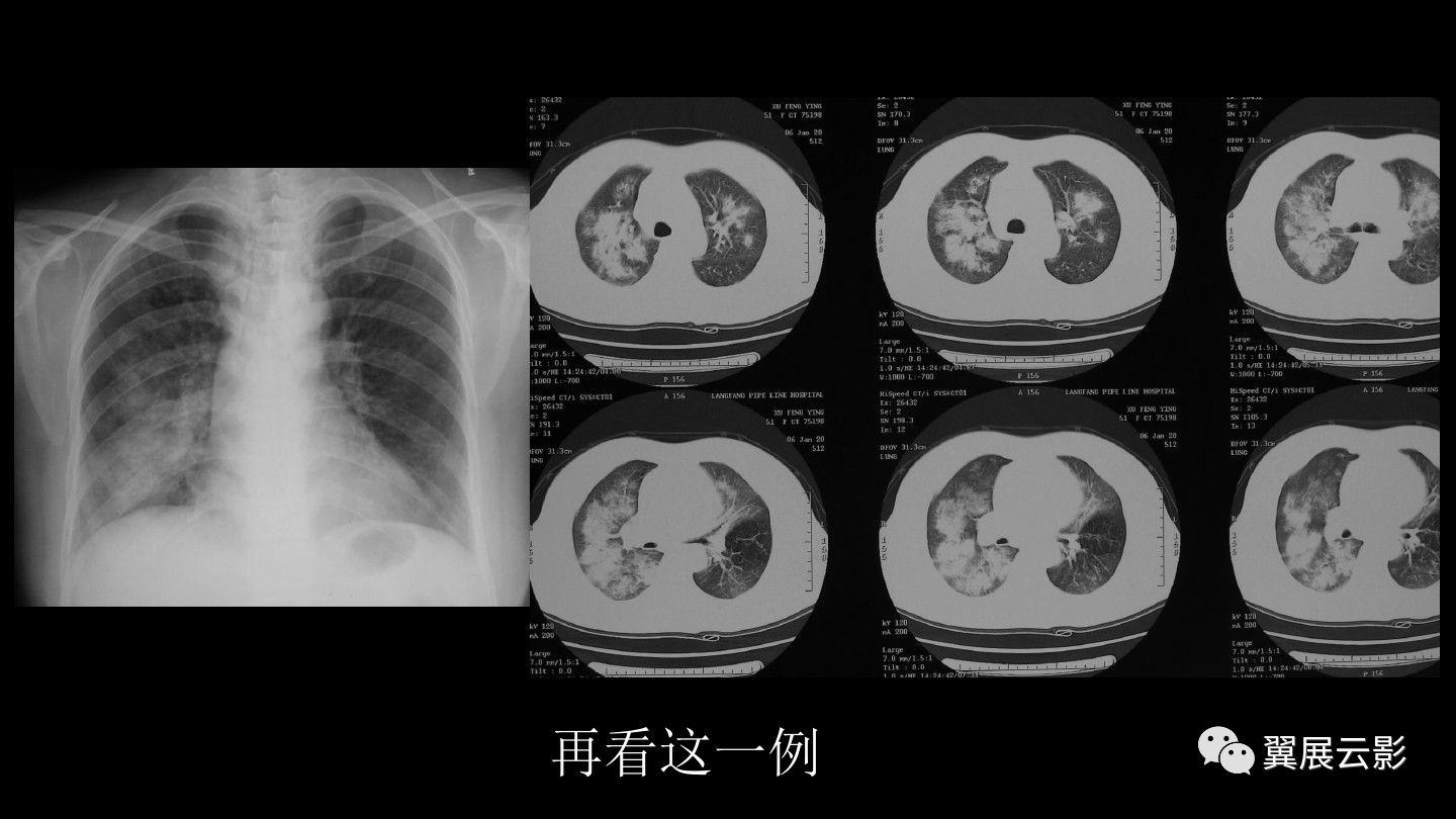 急性呼吸窘迫综合征ards的影像学表现