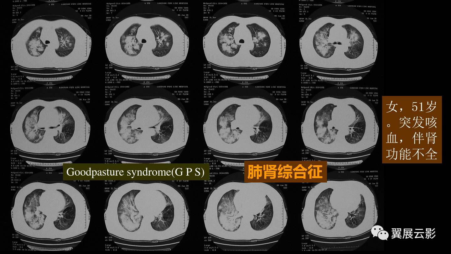 急性呼吸窘迫综合征ards的影像学表现