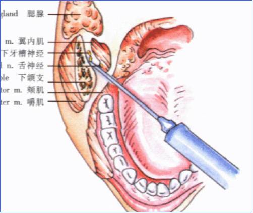 7,颊神经阻滞麻醉适应症:下颌磨牙拔除,颊部手术