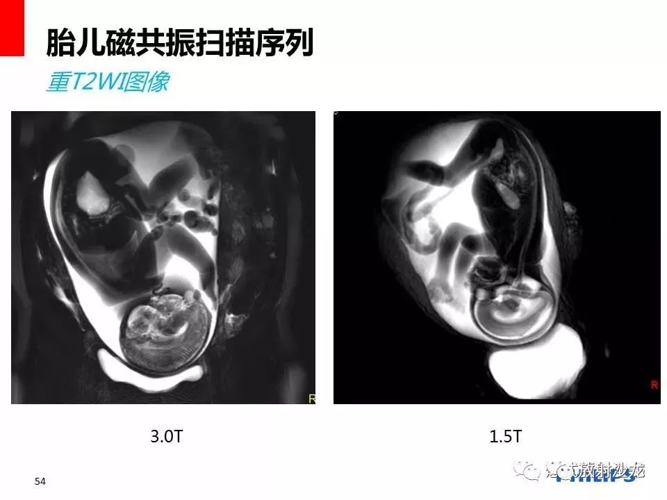 孕妇做核磁共振胎儿图图片