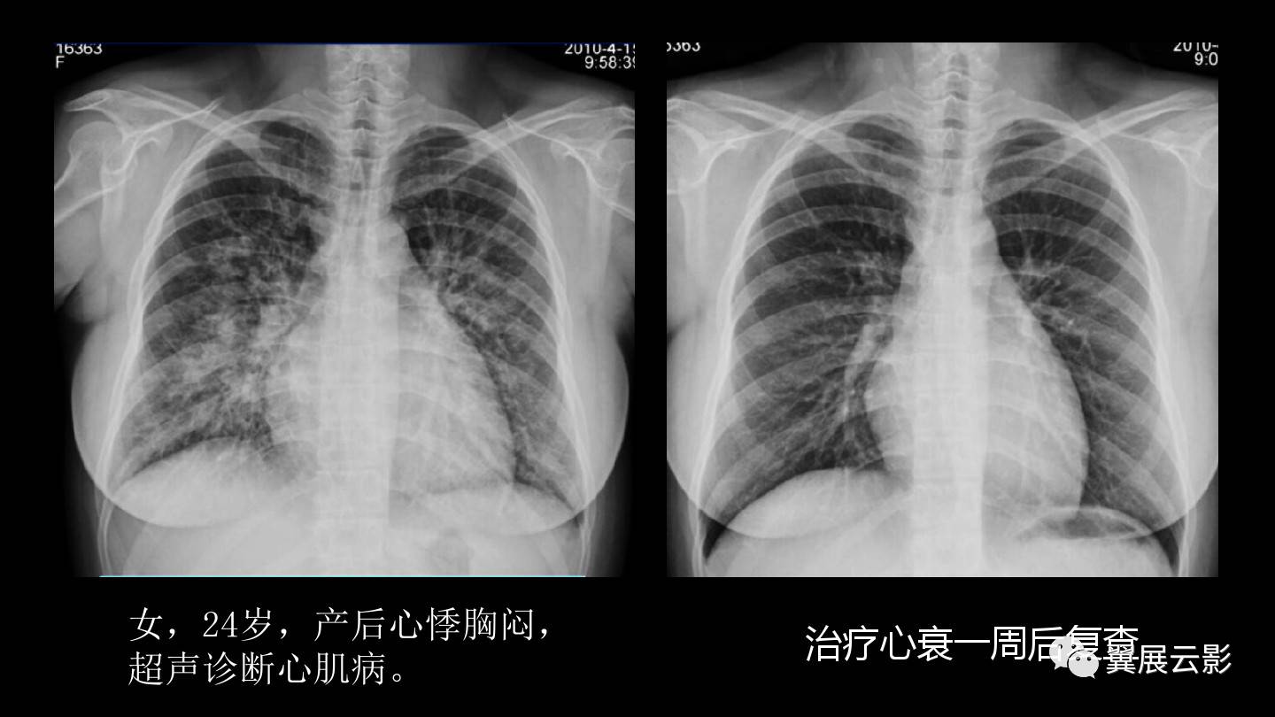 急性呼吸窘迫综合征ards的影像学表现