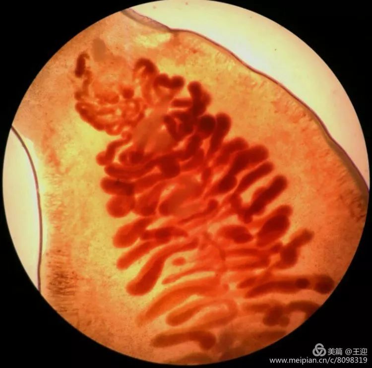 华支睾吸虫(又称肝吸虫)感染1例
