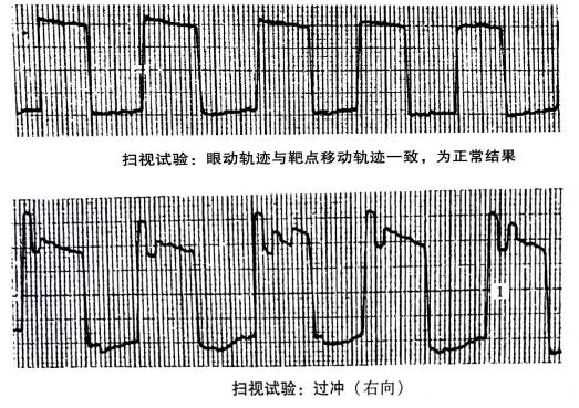 眼震电图多长时间图片