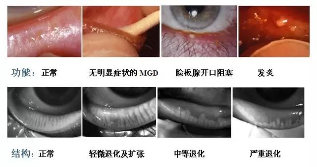 眼涩,痒,疲劳等不适,此时常已伴有睑板腺功能障碍,结膜炎症等轻度损害