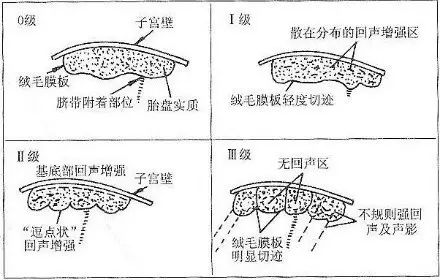 胎盘成熟度2级图片