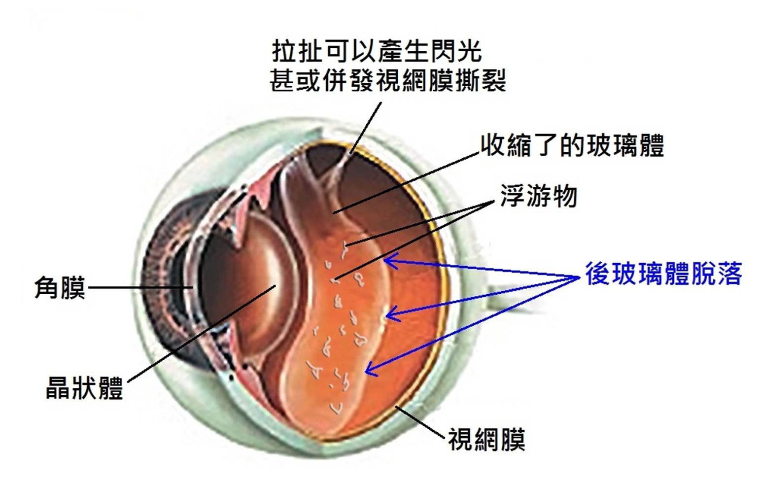 视网膜脱落看东西图片