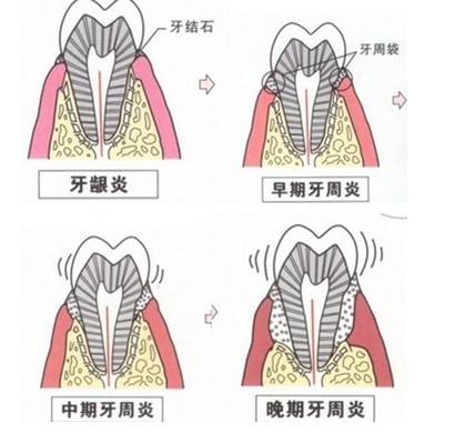 即便每天认真的刷牙,仍免不了有些部位存有牙菌斑,因 此牙周炎很容易