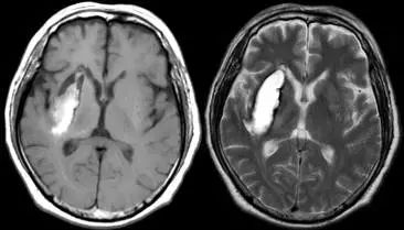 脑出血亚急性晚期t1 高信号(左,t2 高信号(右)命运震怒不已,这些轻贱