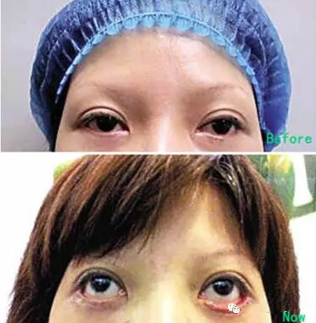 传统的眼袋手术,切除过多眼皮造成眼睛变形,甚至眼睑下拉或外翻,形同