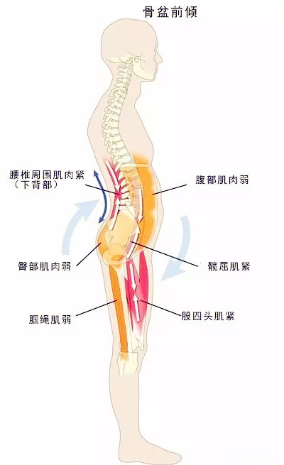 骨盆前倾太弱的肌肉:下斜方肌,三角肌后侧,冈下肌和小圆肌太紧的肌肉
