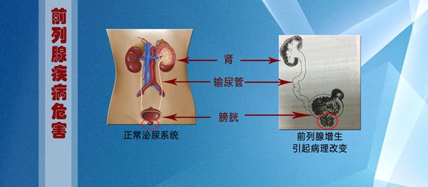 由于前列腺包裹着尿道,所以如果前列腺生了病,男性排尿就会受到影响