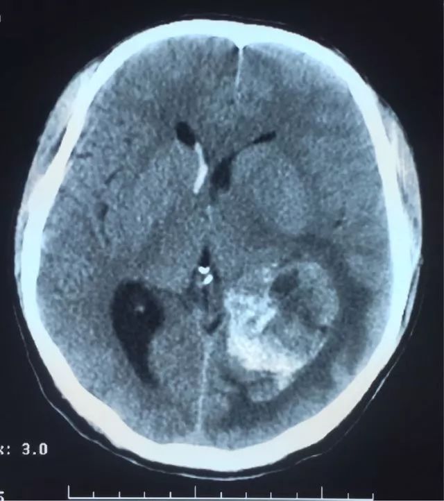 脑肿瘤片子图片