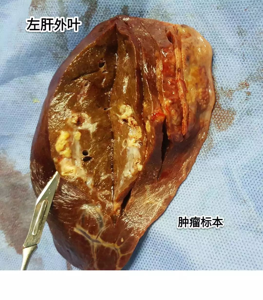 肝肿瘤长什么样图片图片