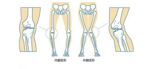 ③四肢6個月以上小兒手腕,足踝部骨骺類骨組織增生形成環狀鈍圓形隆起