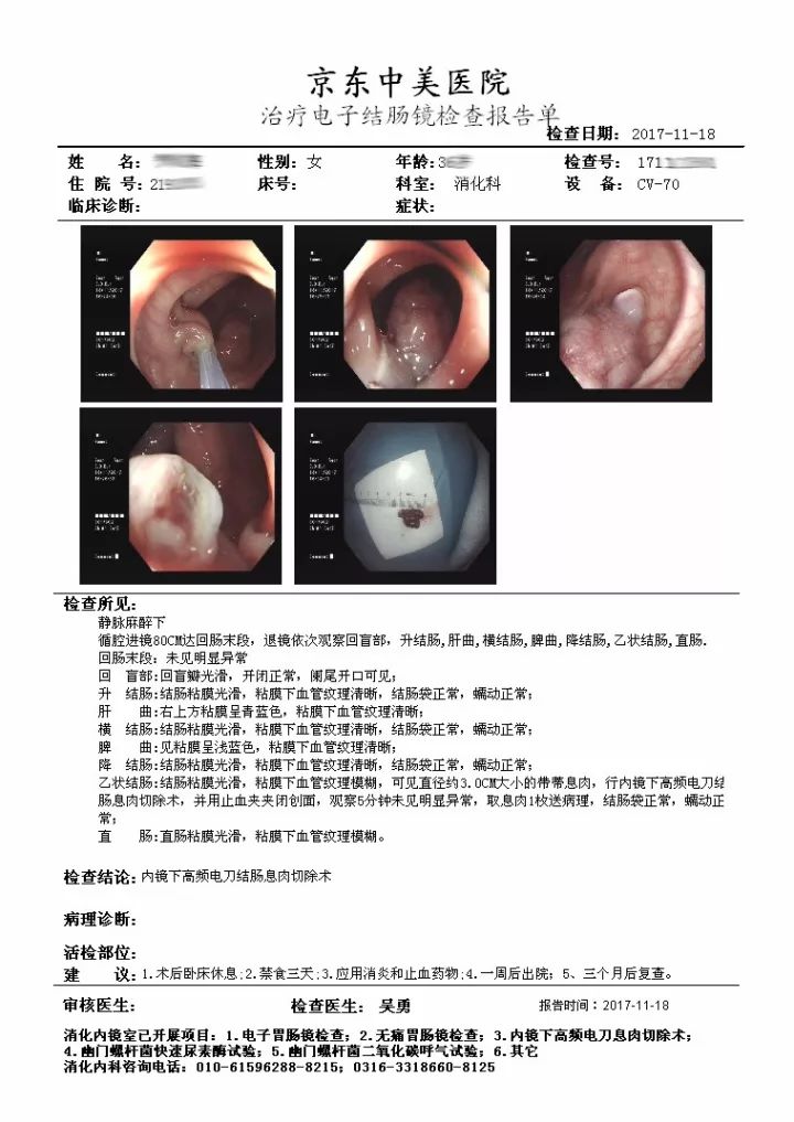 高頻電凝切,鈦夾夾閉創面,對帶蒂巨大息肉予結紮環套扎,根部鈦夾,再用