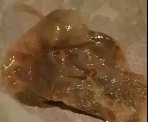 太牛了3袋沙棘茶給子宮洗個澡排出了5個子宮肌瘤