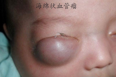 小宝宝血管瘤图片图片