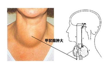 甲亢是什么甲亢早期症状有哪些