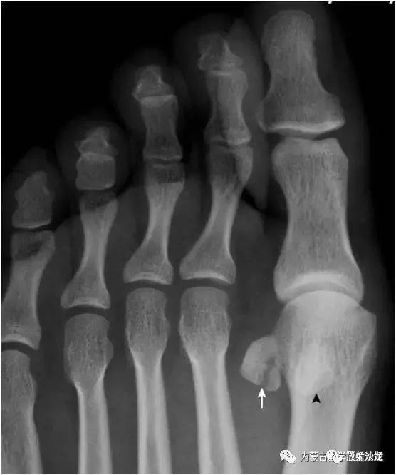 拇趾外侧籽骨形态不完整,内侧见透亮线(箭),两部分骨对应缘不规整,无