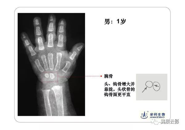 骨骼闭合片子手骨对比图片