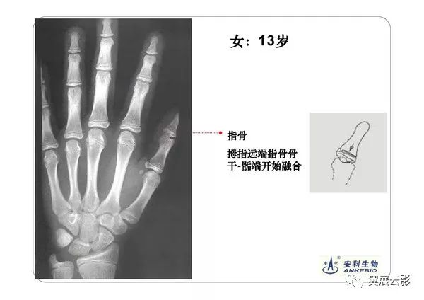 儿童手部骨骼发育图图片