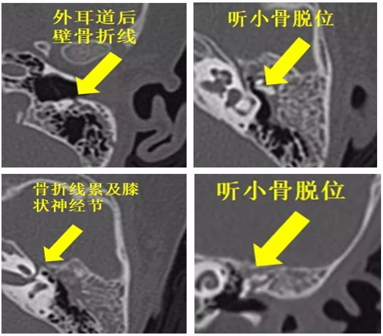 術前ct:ct提示顳骨縱行骨折,骨折線經外耳道後壁至鼓室,累及膝狀神經