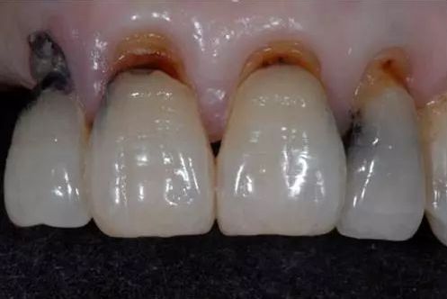牙齿楔状缺损初期图片图片