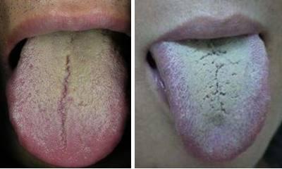 胰腺炎的舌苔图片图片