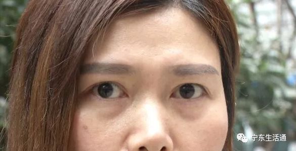 35歲女子花18000割雙眼皮後下垂 醫院:因地球引力