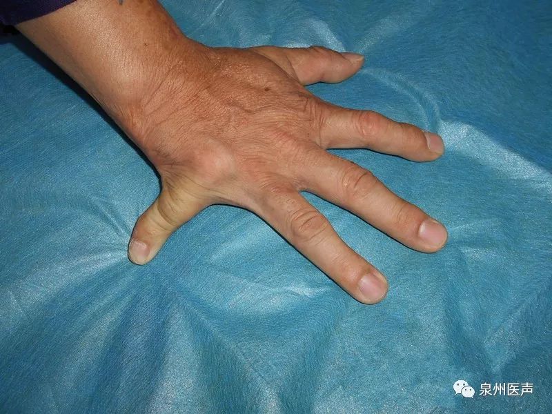 一场迟到36年的手术,矫正偏离约85°的畸形手指