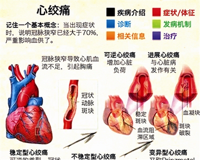 早期心绞痛的症状