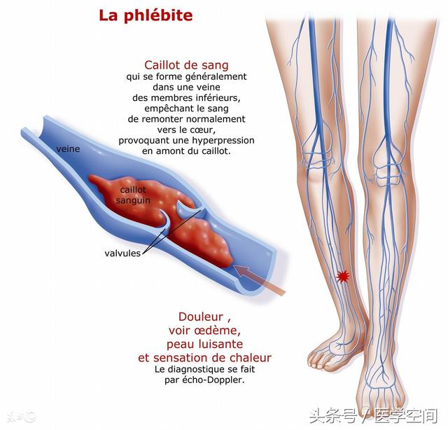 是血液在深静脉内不正常凝结引起的静脉回流障碍性疾病,常发生于下肢