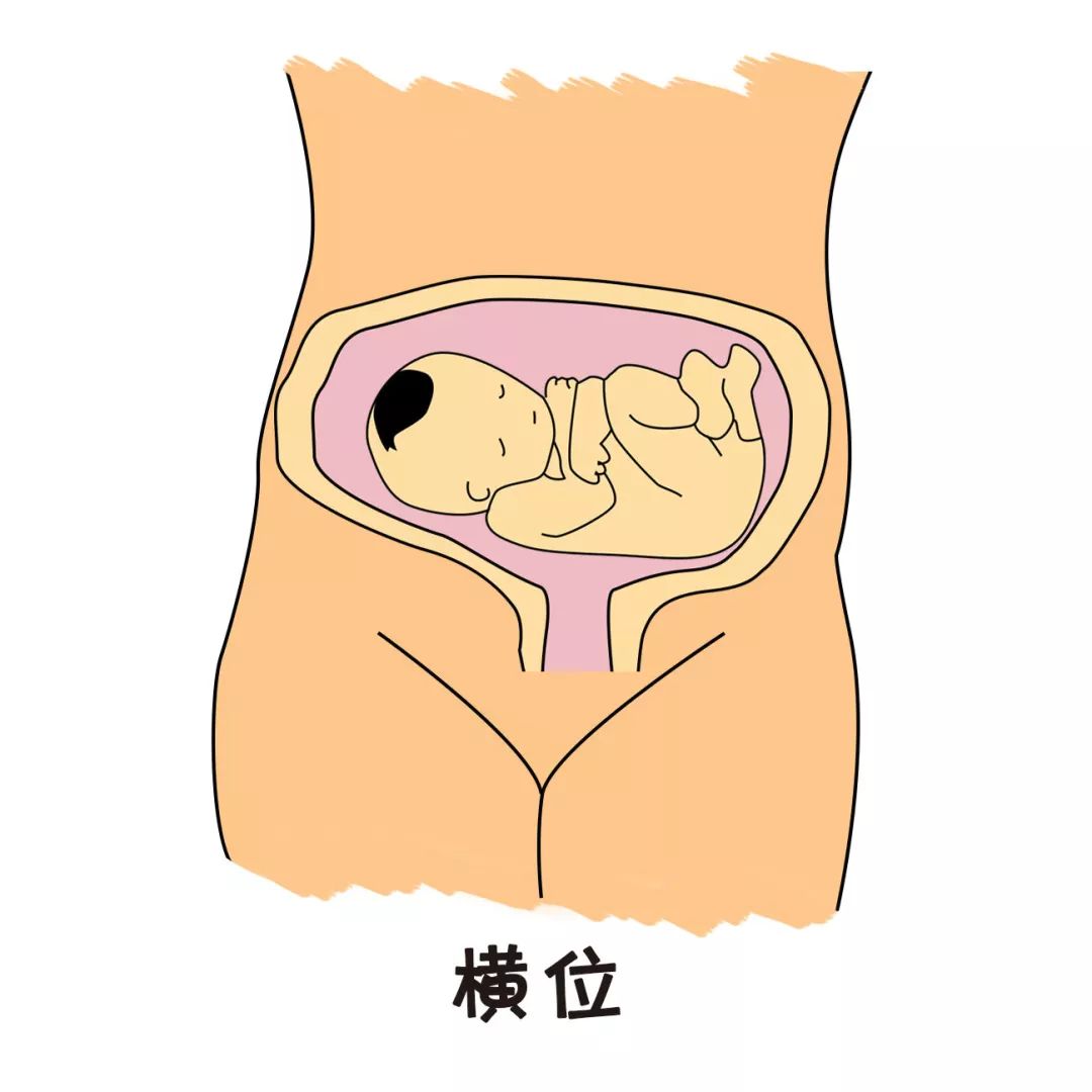 横位是一种少见的最不利于顺产的异常胎位宝宝横躺在孕妈的肚子头朝向