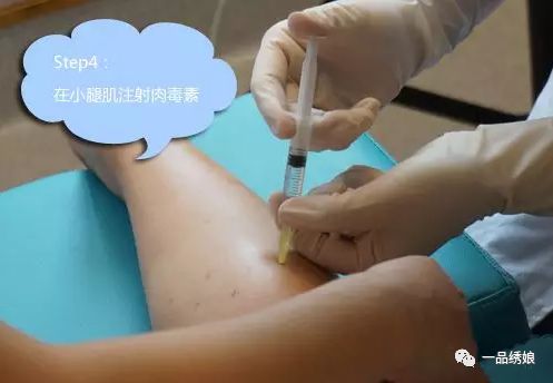 肝素打大腿正确示意图图片