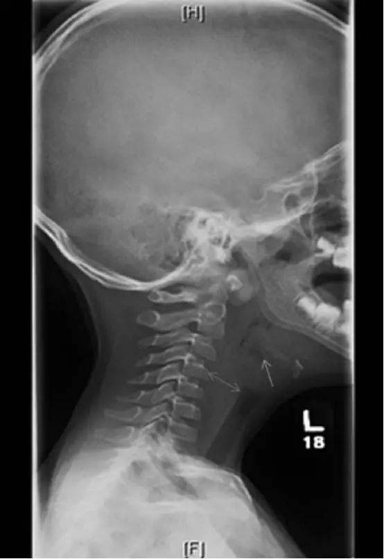 圖1 頸部側位軟組織x線顯示頸椎前軟組織增厚(雙箭),會厭和杓會厭皺襞