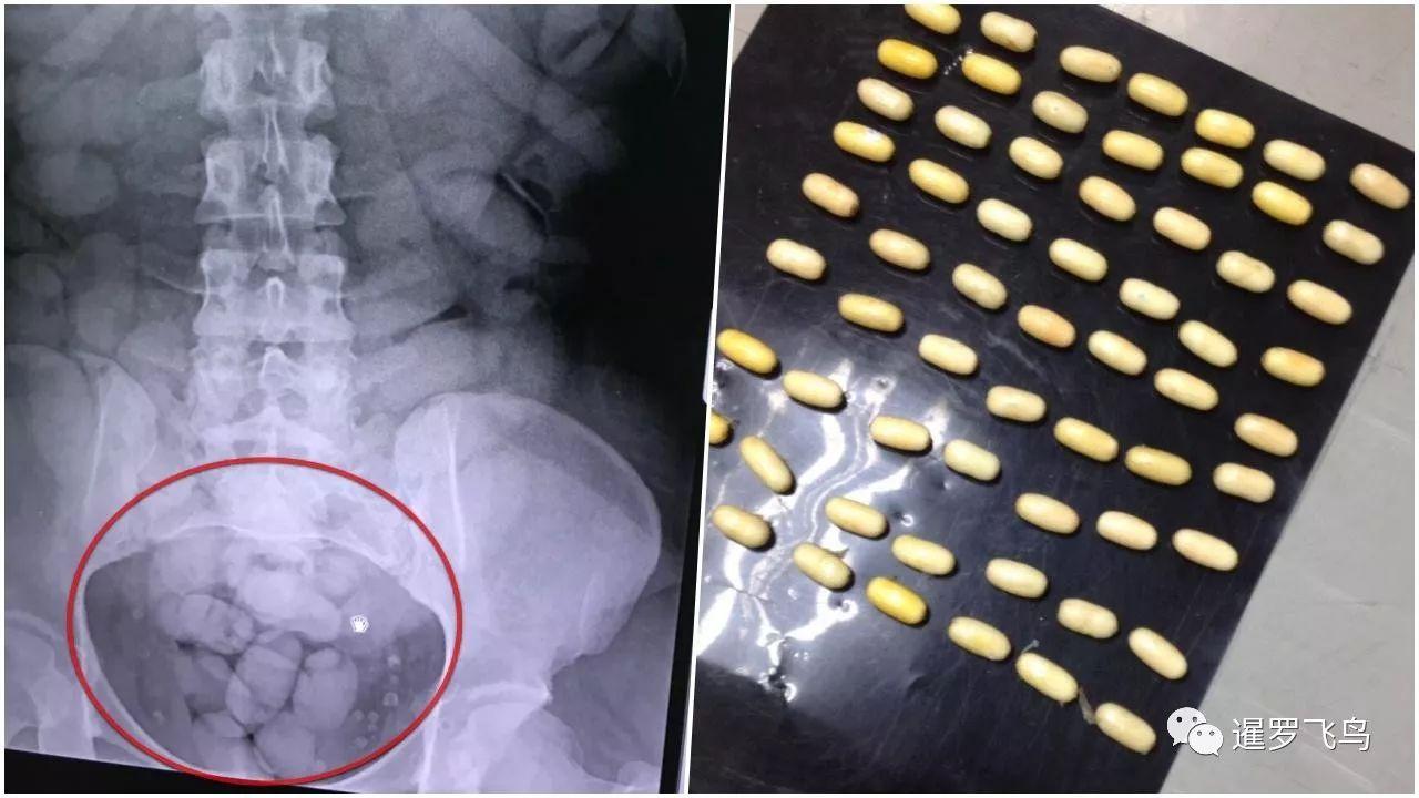 体内藏毒死亡图片