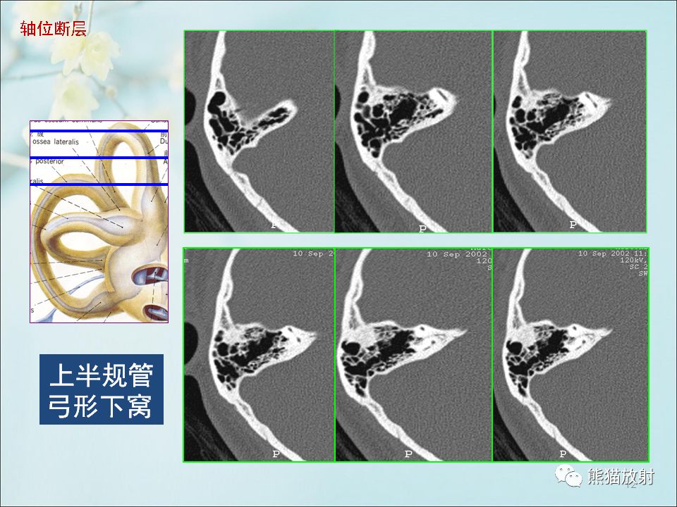 柳澄讲坛颞骨ct断层解剖第一部分连续断层