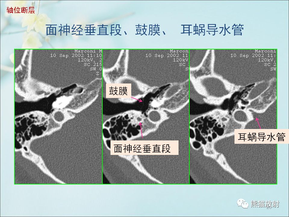 柳澄讲坛颞骨ct断层解剖第一部分连续断层