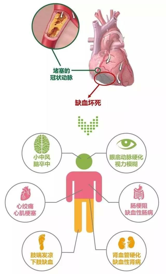 周圍動脈血管發生堵塞,患者會出現下肢間歇性跛行,疼痛,甚至因壞疽而